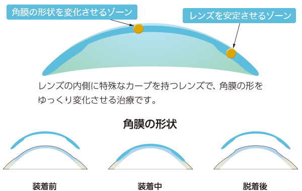 オルソケラトロジーの仕組み：特殊なレンズデザインが角膜の形状を矯正